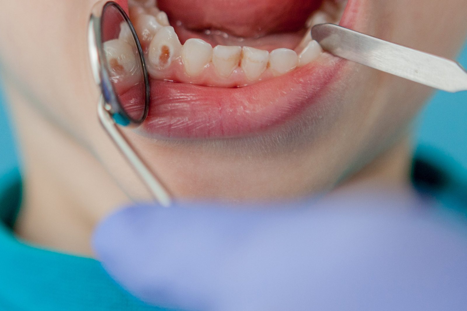 Caries