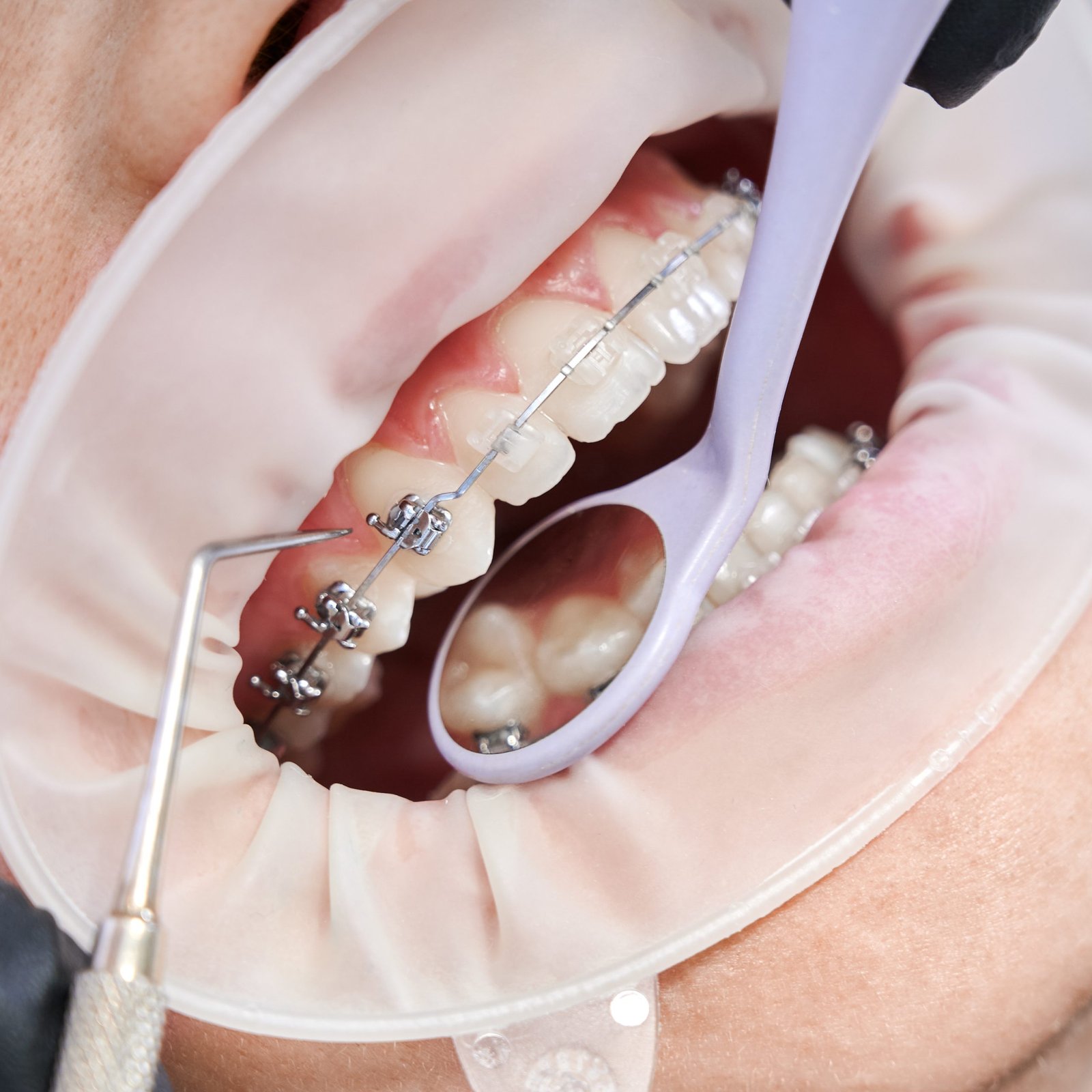 Brackets