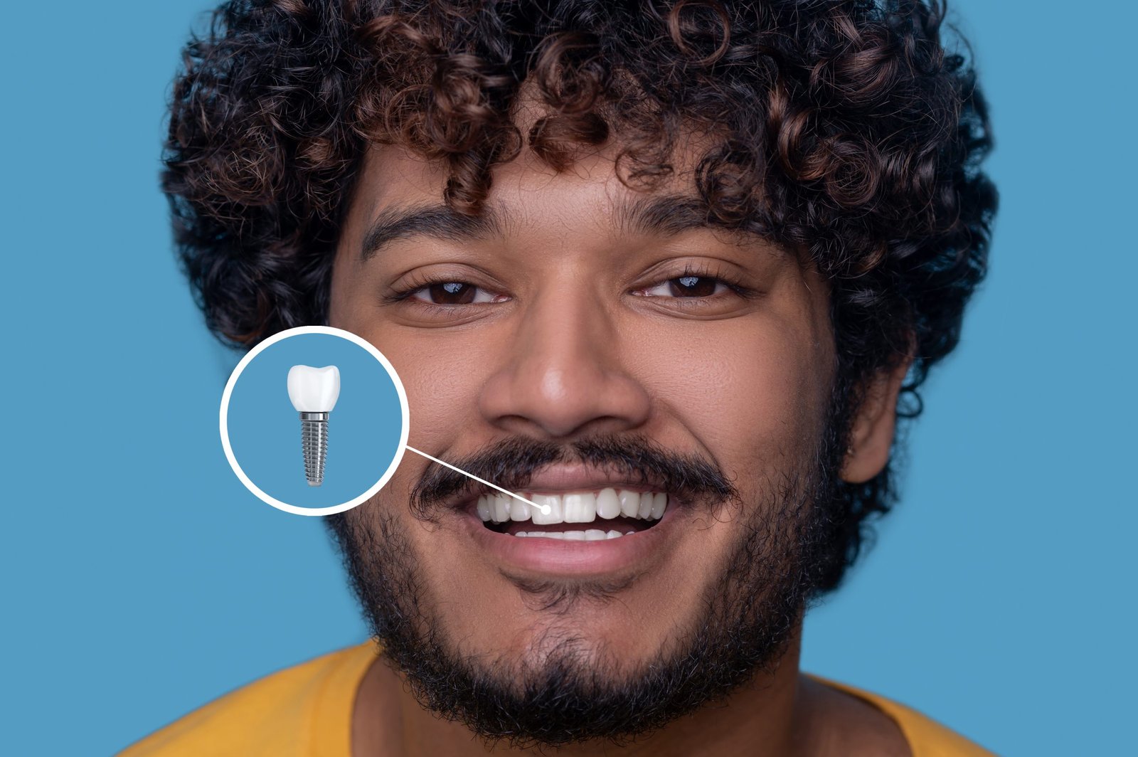 Implantes dentales